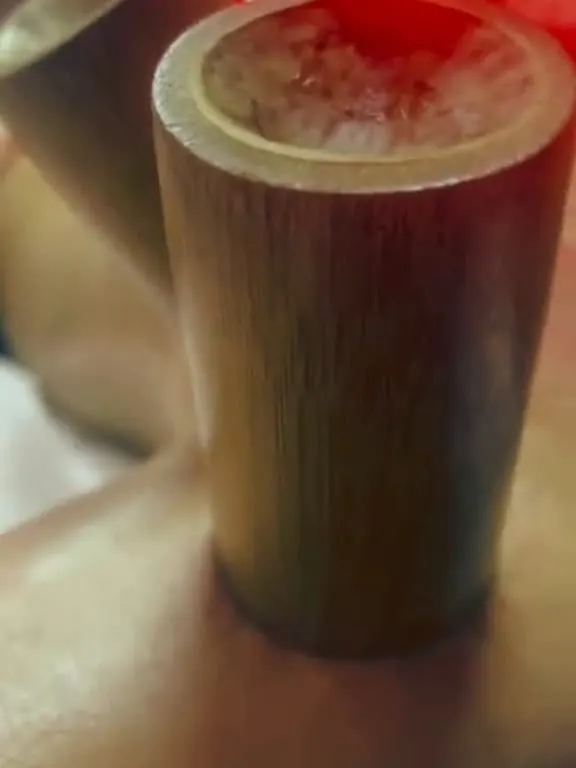 Cups geplaatst op de rug tijdens een behandeling